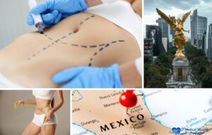 Collage que muestra marcas de cirugía estética en el abdomen, una mujer midiendo su cintura, el Ángel de la Independencia en la Ciudad de México y un mapa de México, destacando la abdominoplastia en México y la importancia de los cirujanos certificados.