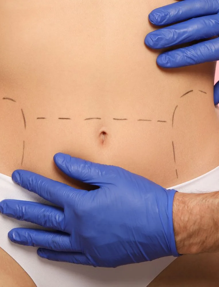 abdominoplasty A person’s midsection with surgical lines drawn on the skin; hands in blue gloves are touching the area, suggesting preparation for a Tummy Tuck (Abdominoplasty), a popular cosmetic procedure in Latin America.