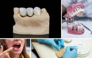 A collage showing dental implants on a model, a dental technician working, a person pointing to their mouth, and a demonstration with an artificial jaw.