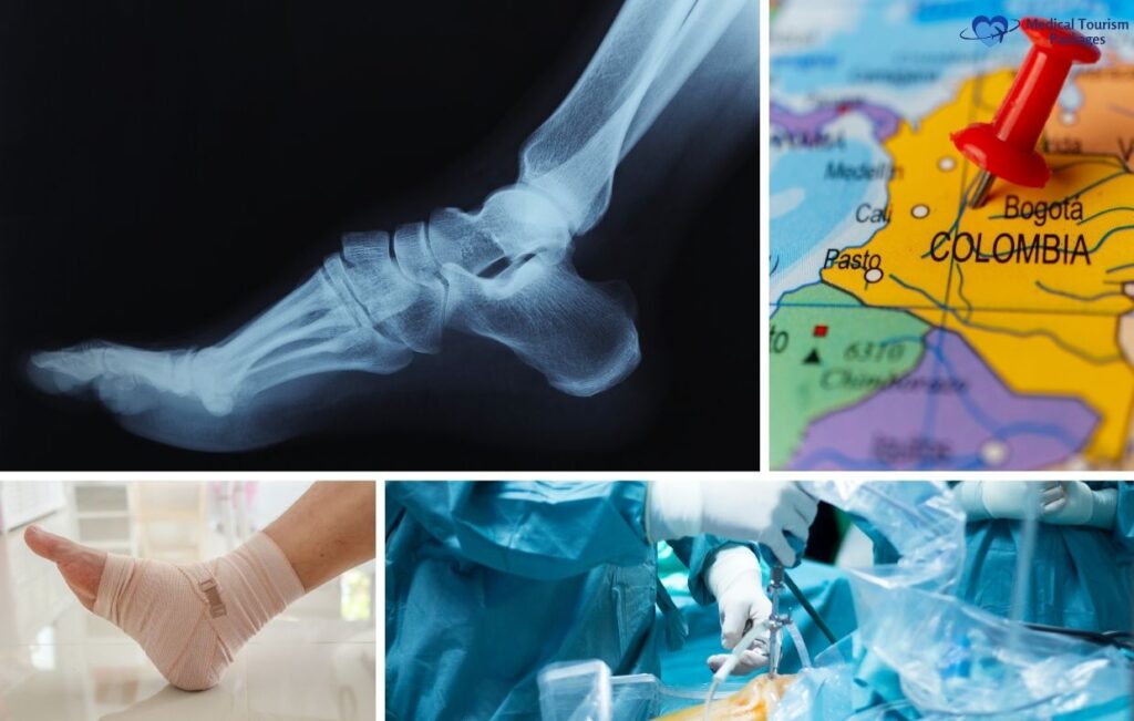 A collage showing a foot X-ray, a map with a pin on Colombia, a bandaged foot, and medical professionals performing Foot & Ankle Surgery—highlighting Colombia as a hub for medical tourism.