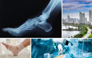 Collage showing an ankle X-ray, a cityscape of Panama, a bandaged foot, and surgeons performing foot and ankle surgery, illustrating themes of medical tourism and orthopedic care.