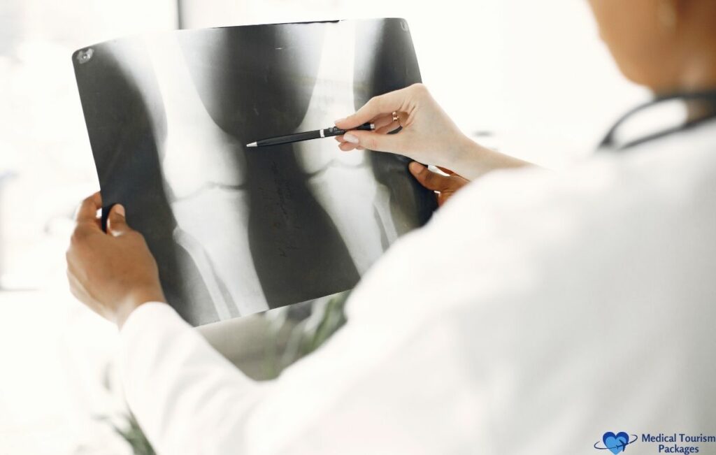 Un médico sostiene y señala con un bolígrafo una radiografía de la articulación de la rodilla, examinando la imagen para su evaluación médica: una escena habitual en el creciente sector del turismo médico en Latinoamérica, especialmente para tratamientos como la terapia con células madre.