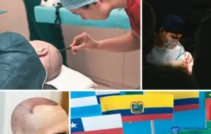 Collage que muestra procedimientos de trasplante capilar, cirujanos operando, un paciente con el cuero cabelludo afeitado, banderas internacionales, e información sobre Hair Implant Latin America con una guía de costos.