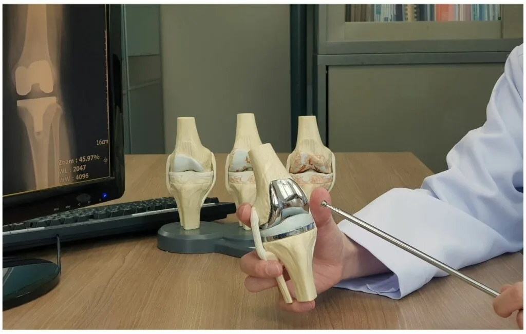 Profesional médico con bata blanca demuestra el procedimiento de reemplazo de rodilla utilizando modelos anatómicos, con pantalla de rayos X en el monitor que muestra imágenes de la articulación de la rodilla y múltiples modelos de articulación de la rodilla en el escritorio de madera que muestran diferentes etapas de la artritis y las opciones de prótesis.