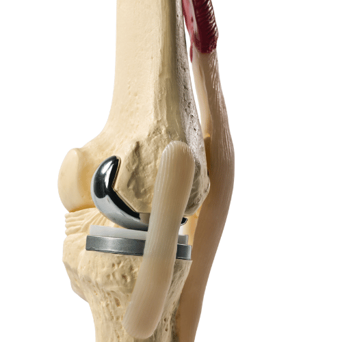 Model of a human knee joint showing a metallic knee replacement implant attached to the femur and tibia, with ligaments and tendons visible, ideal for those exploring wellness travel or medical tourism in Latin America.