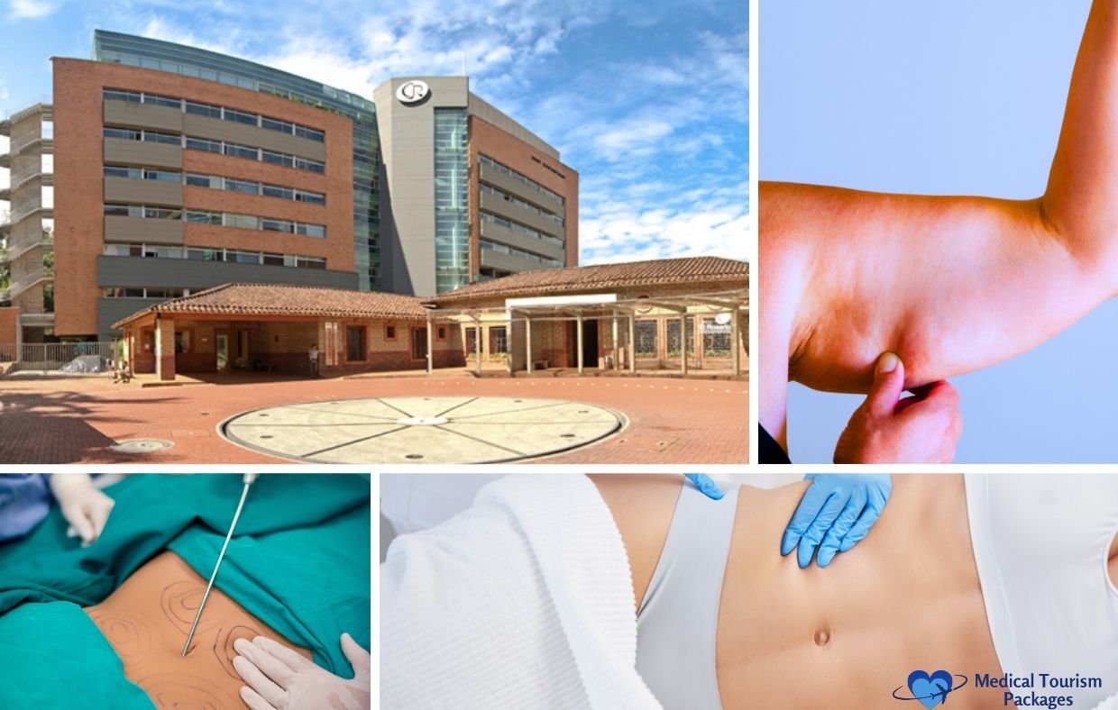 Un collage con un edificio de hospital, una persona pellizcándose la grasa del brazo, marcas de cirugía de liposucción y una mano enguantada examinando el abdomen de un paciente destaca el contorno corporal y la liposucción en Colombia.