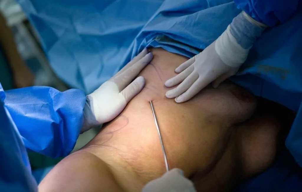 Surgeons perform body contouring during a liposuction procedure, inserting a cannula into the patient's abdomen while wearing surgical gloves and blue drapes.