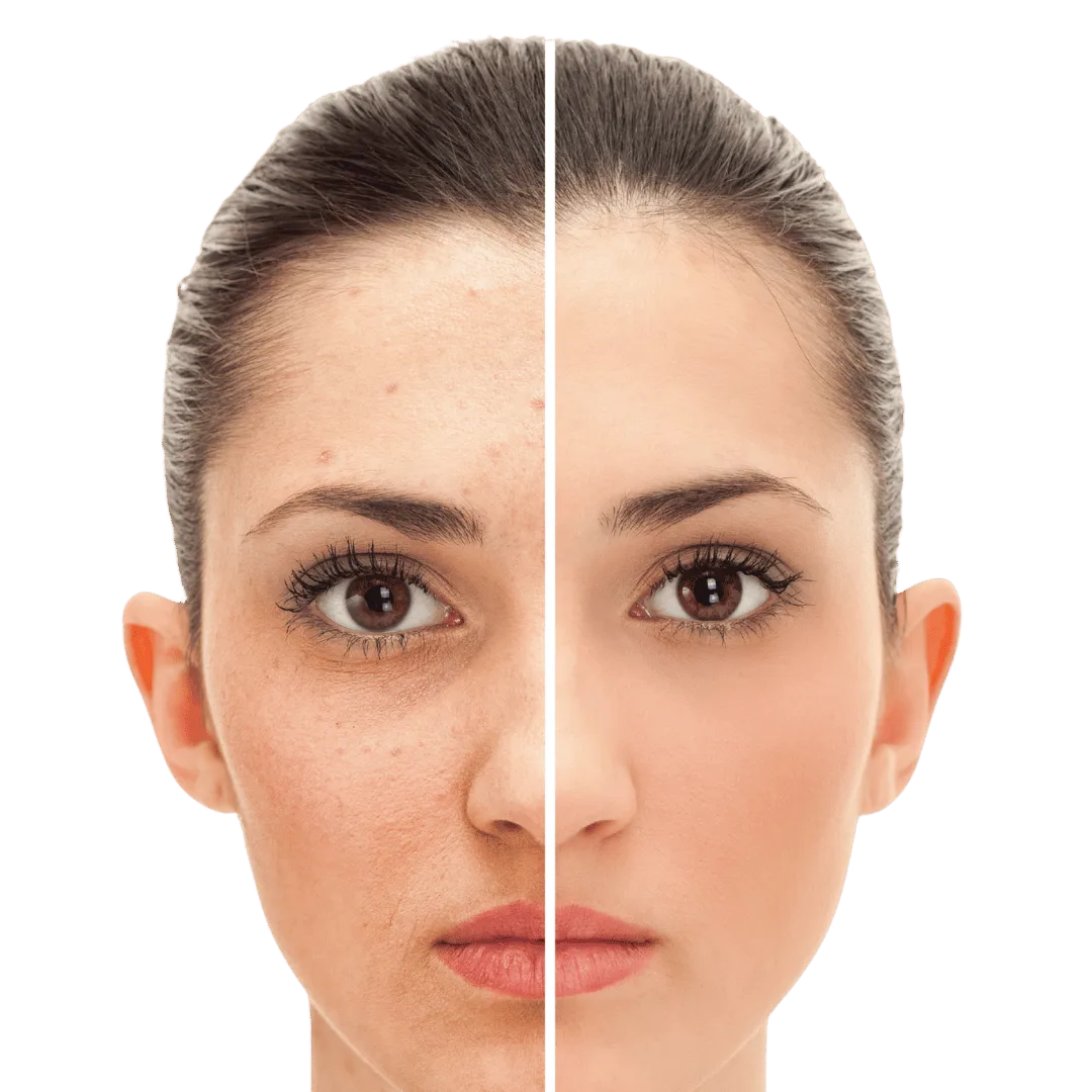 Split image of a woman's face showing skin with acne and texture on the left side, and smooth, clear skin on the right side.