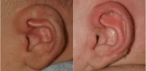 Otoplasty procedure in modern medical facility