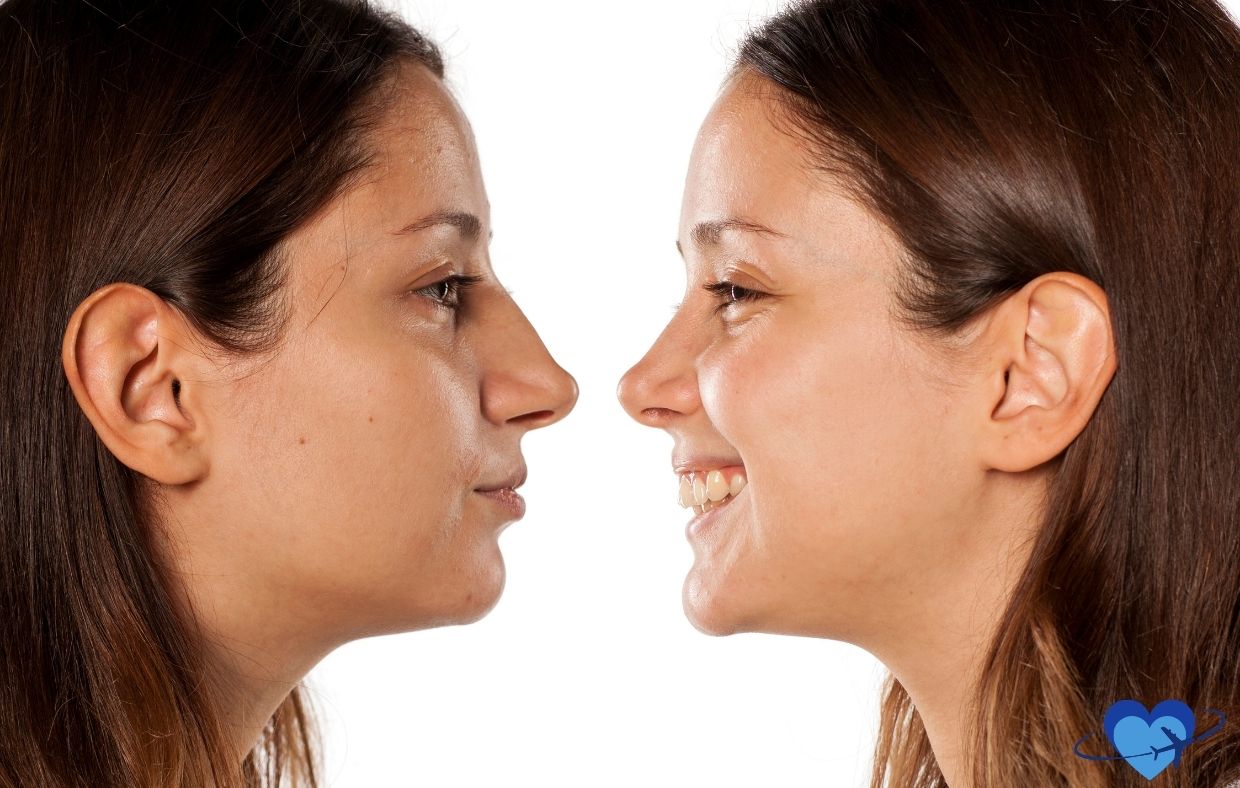 Two images of the same woman, post-rhinoplasty, facing each other; one is serious, the other smiling. Both profiles elegantly highlight her transformation set against a white background, a testament to Colombia’s esteemed cosmetic artistry.