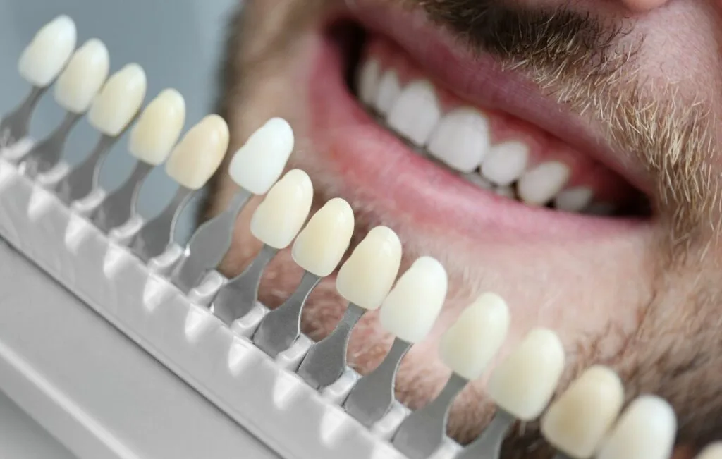 Primer plano de la boca de un hombre sonriente en Colombia con una guía de colores dentales que muestra varias muestras de colores para carillas dentales delante de sus dientes.